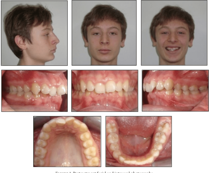 Class division malocclusion ii slideshare