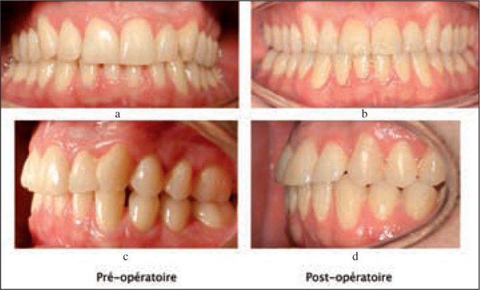 Class ii malocclusion div slideshare