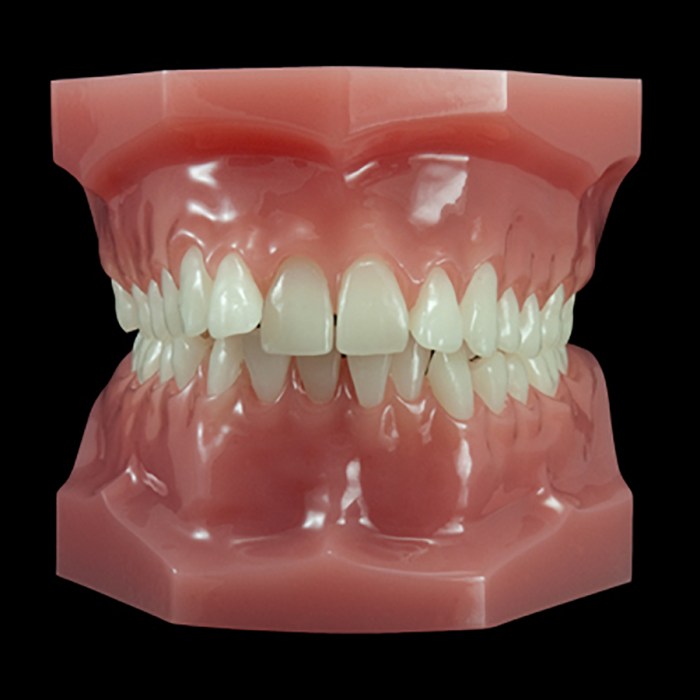 Class ii malocclusion division 2