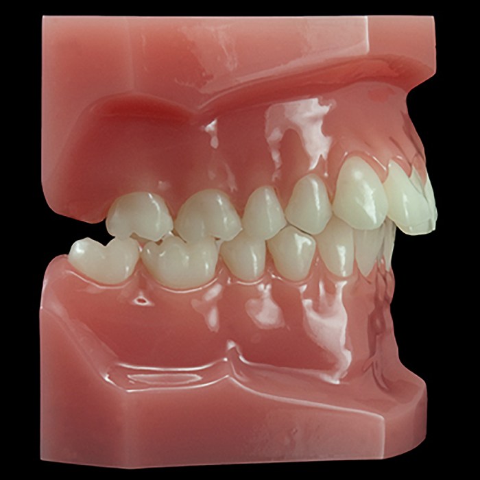 Class ii malocclusion division 2