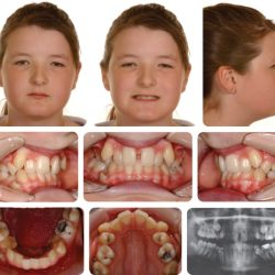 Division malocclusion angle occlusion linden severity sharedoc