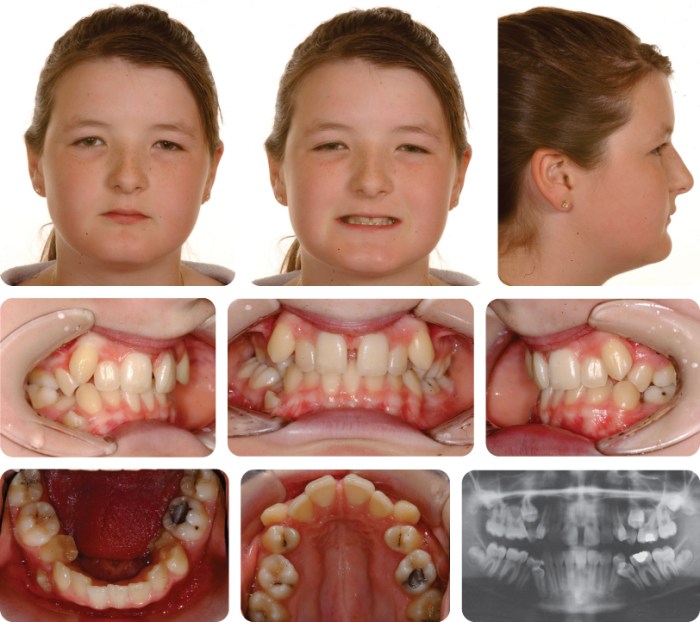 Division malocclusion angle occlusion linden severity sharedoc