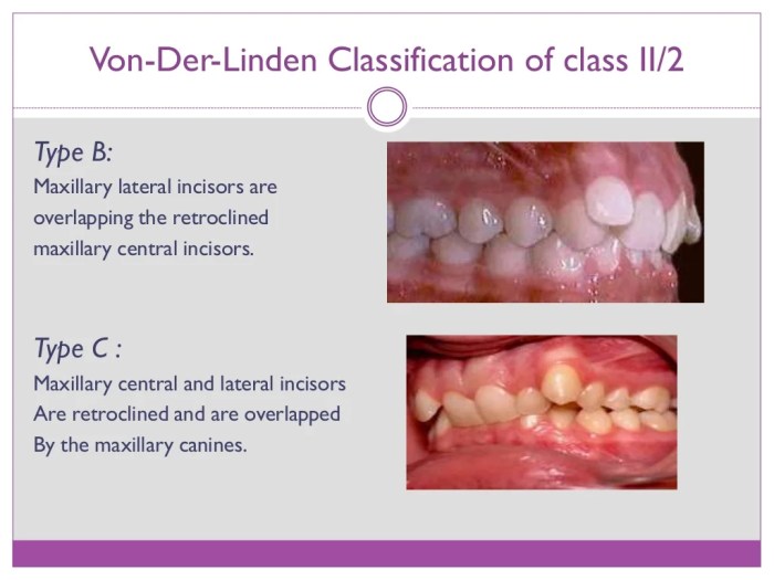 Class division malocclusion ii treatment plan pocketdentistry